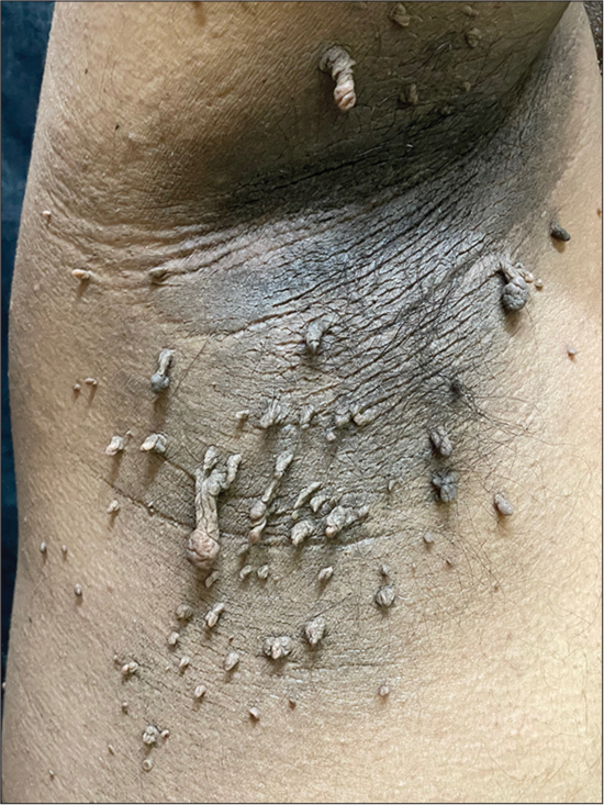 Axilla showing elongated, pedunculated, and convoluted acrochordons superimposed on acanthosis nigricans, a common finding in obese patients.