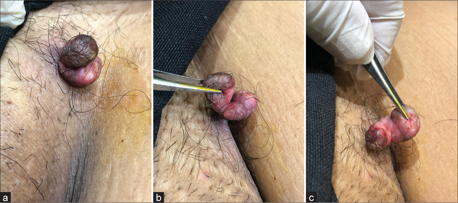 (a) Bilobed acrochordon in groin arising from a single stalk. (b) One lobe is pigmented and rugose, while the other is skin colored and swollen. (c) Adjacent surfaces show inflammatory changes.