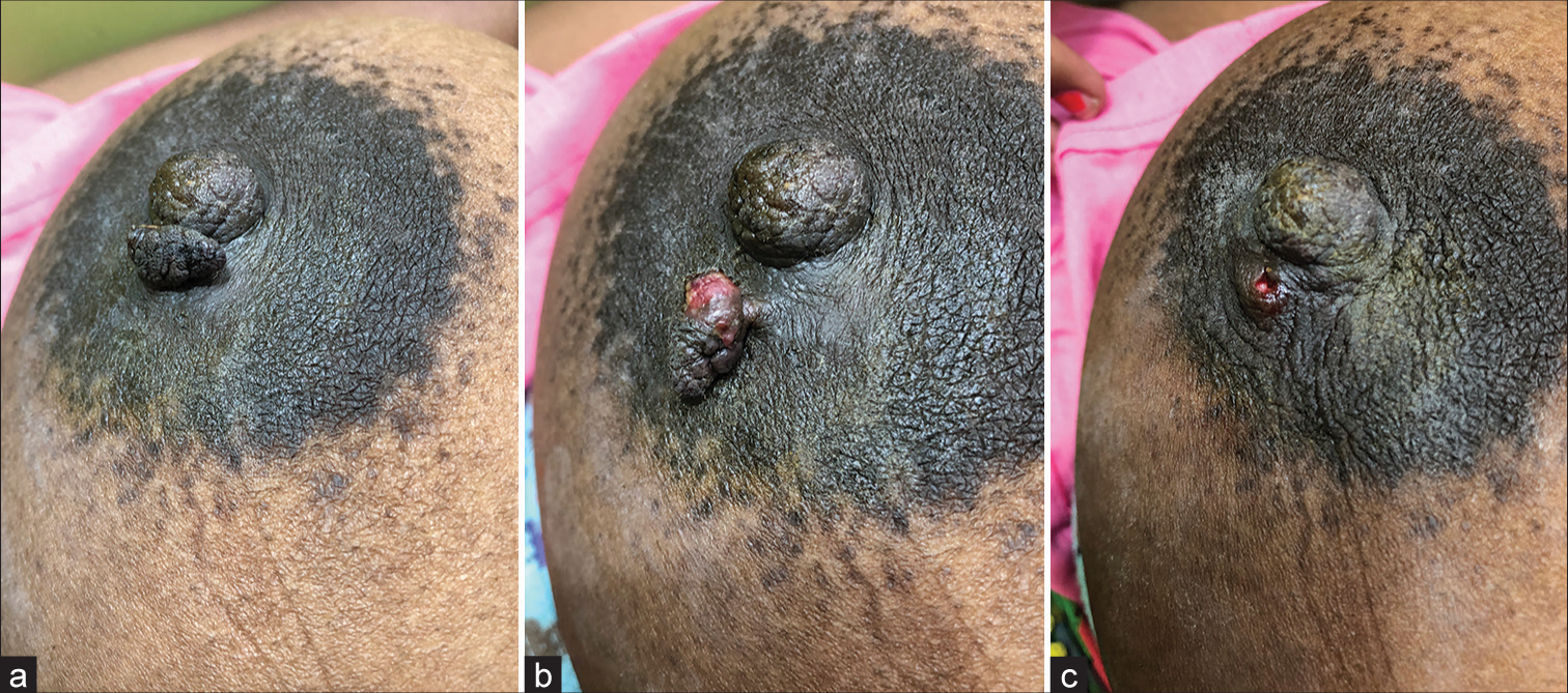 (a and b) Areolar skin tag with an eroded undersurface. (c) Base after removal by radiofrequency cautery.