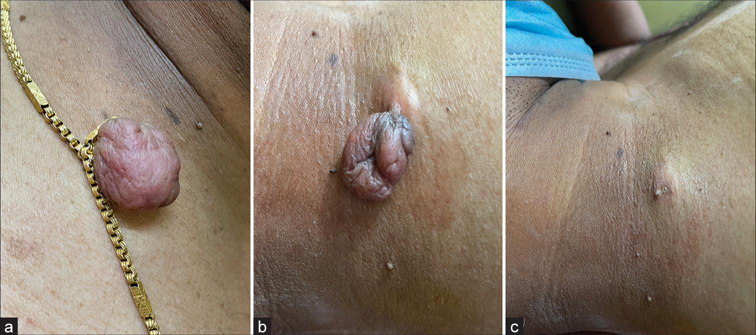 (a) Skin tag (ST) engorged due to neck chain strangulating the stalk. (b,c) Swollen base of ST before and after radiofrequency cautery.