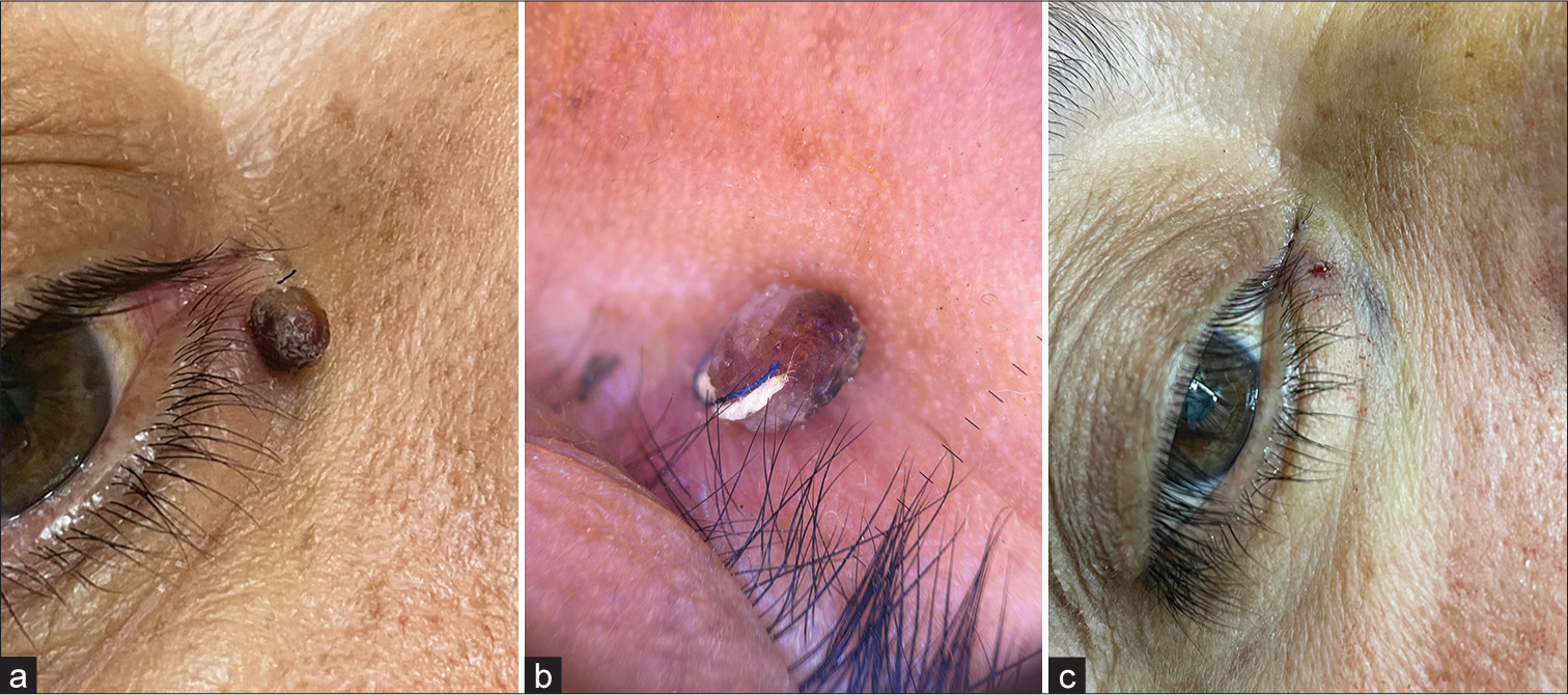 (a and b) Skin tag on the lower eyelid, strangulated by a blue and white thread that was visualized by dermoscopy. (c) Post-cautery image.