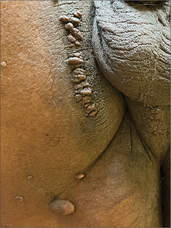 Linear arrangement of skin tags overlying acanthosis nigricans.