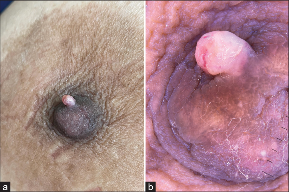 (a) Flesh-colored skin tag over the nipple. (b) The same lesion was visualized on the dermatoscope.