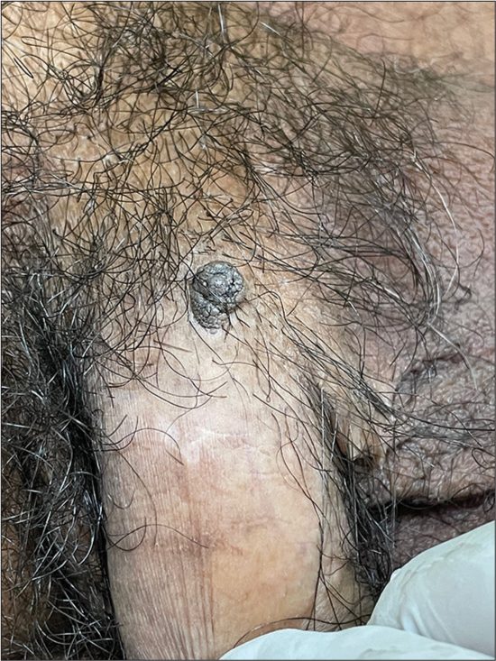 Pigmented, cerebriform skin tag on the base of penile shaft mimicking a seborrheic keratosis.