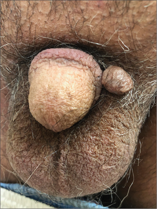 Large skin tag on the scrotum adjacent to the penis.