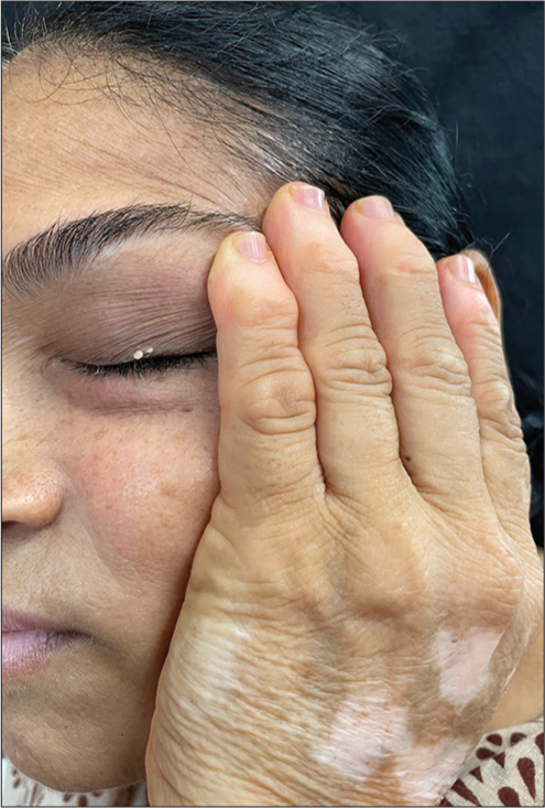 Tiny, depigmented skin tags on the eyelid margin of a vitiligo patient.