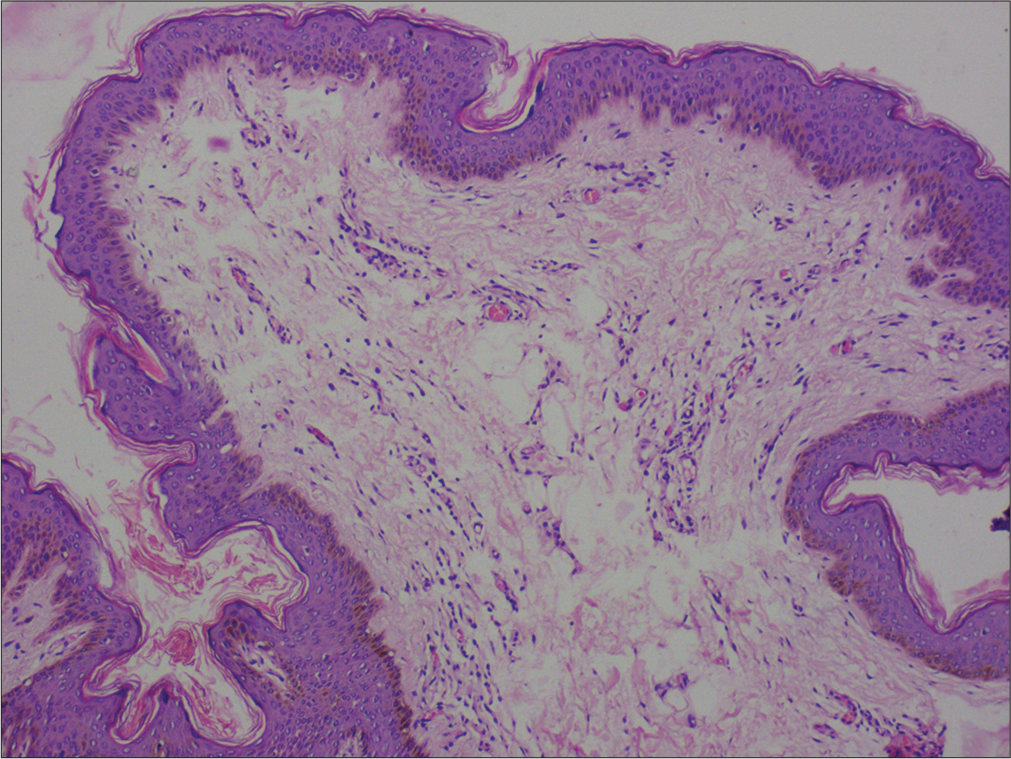 Histopathology of a skin tag. Normal to the minimally atrophic epidermis, increased basal layer pigmentation, loosely-arranged thin collagen fibers in the dermis, and increased blood vessels (Hematoxylin and eosin, ×100).