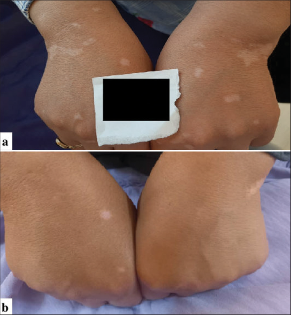 (a) Clinical photographs of a 51-year-old female with refractory vitiligo lesions on both hands before treatment and (b) 6 months after the final treatment session. The patient’s right hand treated with a combination of fractional carbon dioxide (FCO2) laser, excimer lamp therapy, and platelet-rich plasma demonstrates >75% repigmentation. The patient’s left hand was treated with a combination of FCO2 laser, excimer lamp therapy, and topical tacrolimus 0.1% shows between 50% and 75% repigmentation.