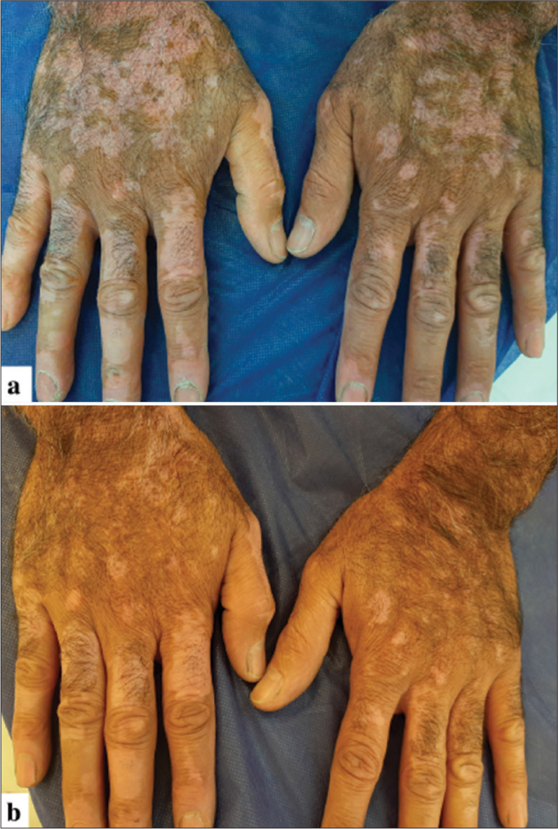 (a) Clinical photographs of a 56-year-old male with refractory vitiligo lesions on both hands before treatment and (b) 6 months after the final treatment session. The patient’s right hand treated with a combination of fractional carbon dioxide (FCO2) laser, excimer lamp therapy, and platelet-rich plasma demonstrates >75% repigmentation. The patient’s left hand was treated with a combination of FCO2 laser, excimer lamp therapy, and topical tacrolimus 0.1% shows between 50% and 75% repigmentation.