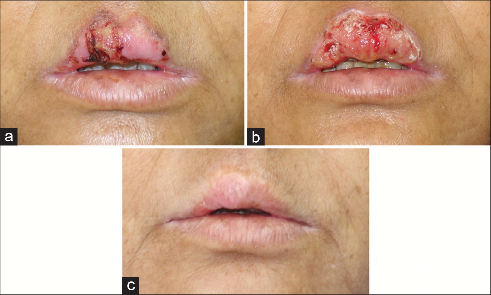 (a) Solitary plaque with prominent thread-like margins associated with ulceration seen over the upper lip. (b) Lesion 2 weeks after first sitting of CO2 laser ablation. (c) Lesion after complete healing, at 2 months after the second sitting.