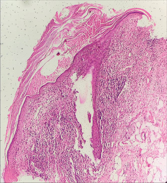 Hyperkeratosis with microabscess formation, diminished malpighian layer, basal layer degeneration, and dermal lymphocytic infiltration (H&E, × 40). H&E: Hematoxylin and eosin.