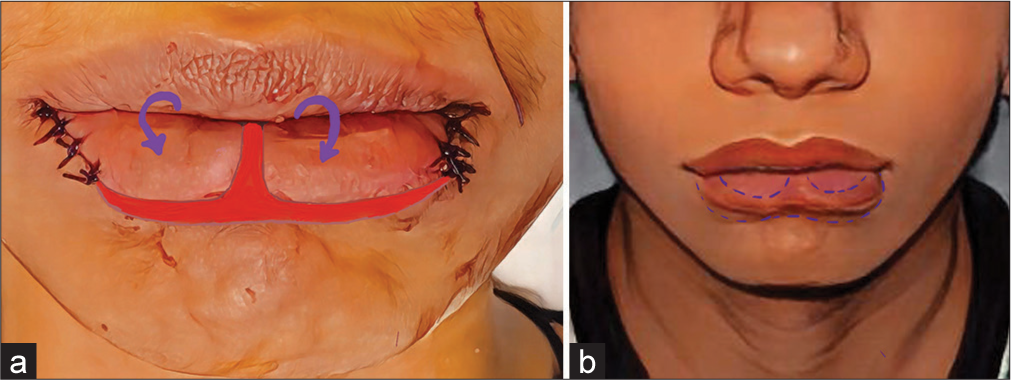 (a) Arrow points to the advancement of labial mucosal flap (b) shows the out turning of the mucosal flap advanced into the defect.