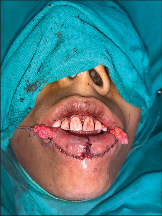 Dermo fat threaded into the tunnel under mucosal advancement flap