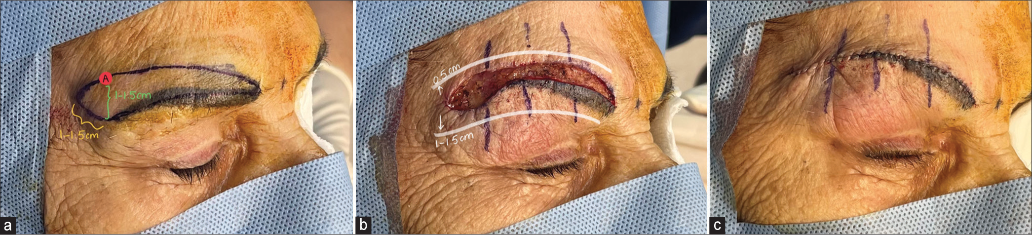 Surgical steps. (a) Creating point “A” and drawing your lines, (b)Undermining technique above and below, (c) Closing the skin.