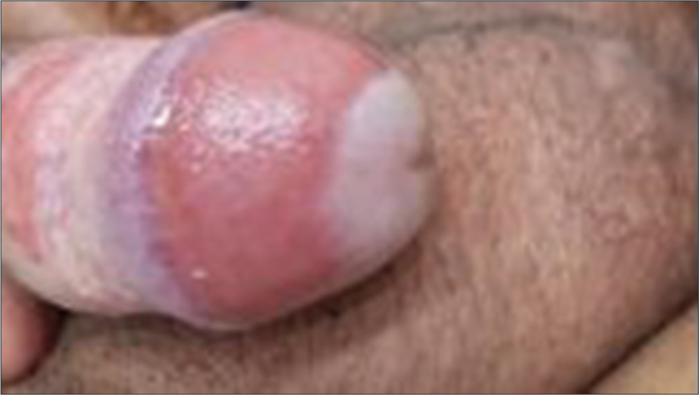 55-year-old male with lesion for 2 years; Pre-treatment.