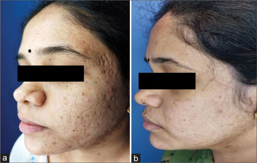 Improvement in the acne scars from (a) Grade 4 to (b) Grade 2 during follow-up (1 month after the last session).