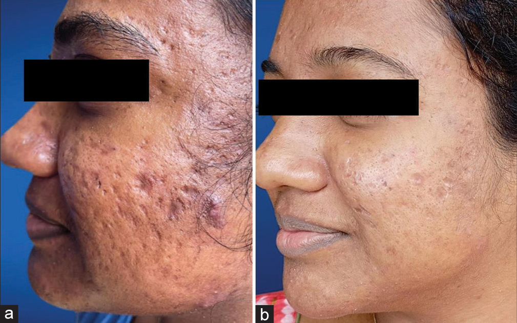 Improvement in the acne scars from (a) Grade 4 to (b) Grade 3 during follow-up (1 month after the last session).