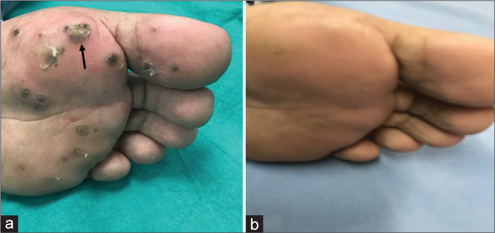 (a) A 28-year-old male patient presenting with a cluster of verruca plantaris on the left foot. The target lesion is indicated by the black arrow. On the first session (week 0) of treatment with intralesional Vitamin D3. (b) At 6 months follow-up, the warts showed a complete response to treatment with intralesional Vitamin D3.