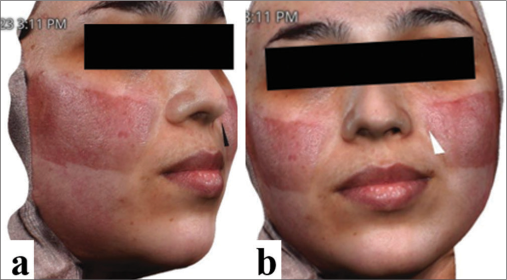 (a) lateral and (b) anterior view of the patient’s face with post-inflammatory erythema secondary from electromedical plasmage.