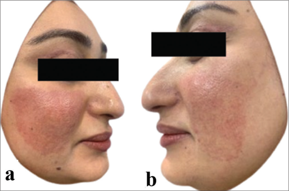 (a) right and (b) left side of the patient’s face with post-inflammatory erythema secondary to fractional carbon dioxide laser.