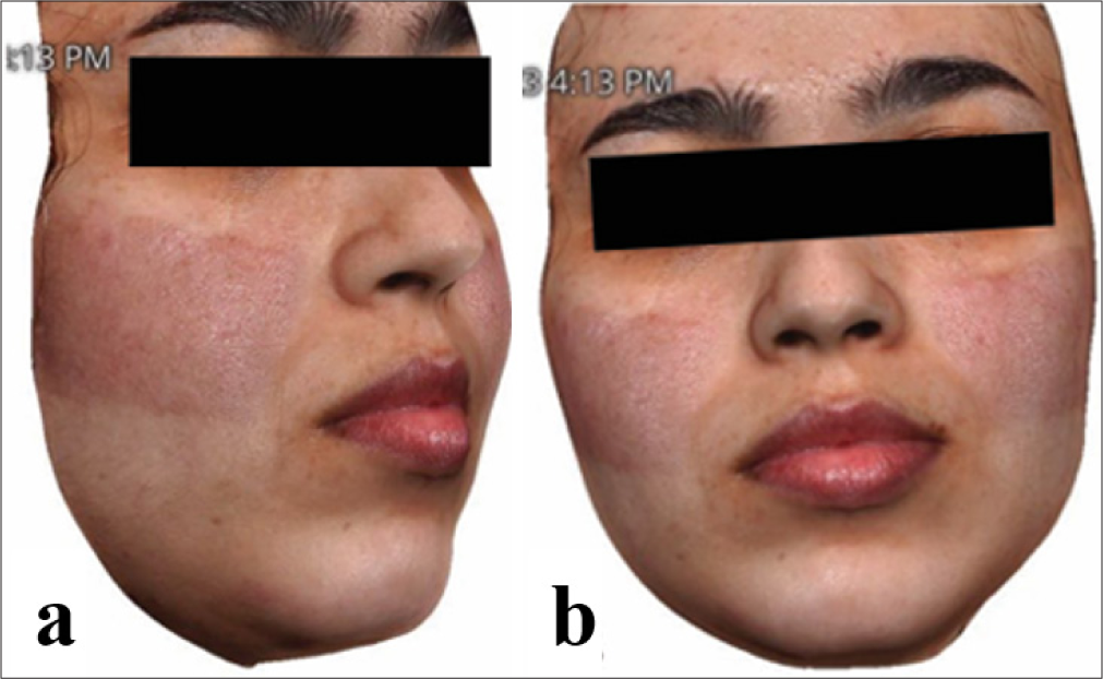 (a) lateral and (b) anterior view of the patient’s face showing significant erythema resolution after four sessions of long potassium-titanyl-phosphate laser.