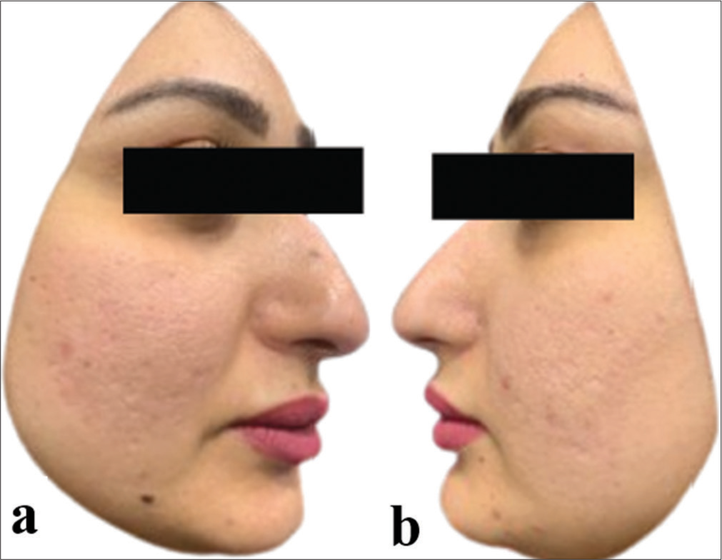 (a) right and (b) left side of the patient’s face showing significant resolution of the erythema after four sessions of long pulse potassium-titanyl-phosphate laser.