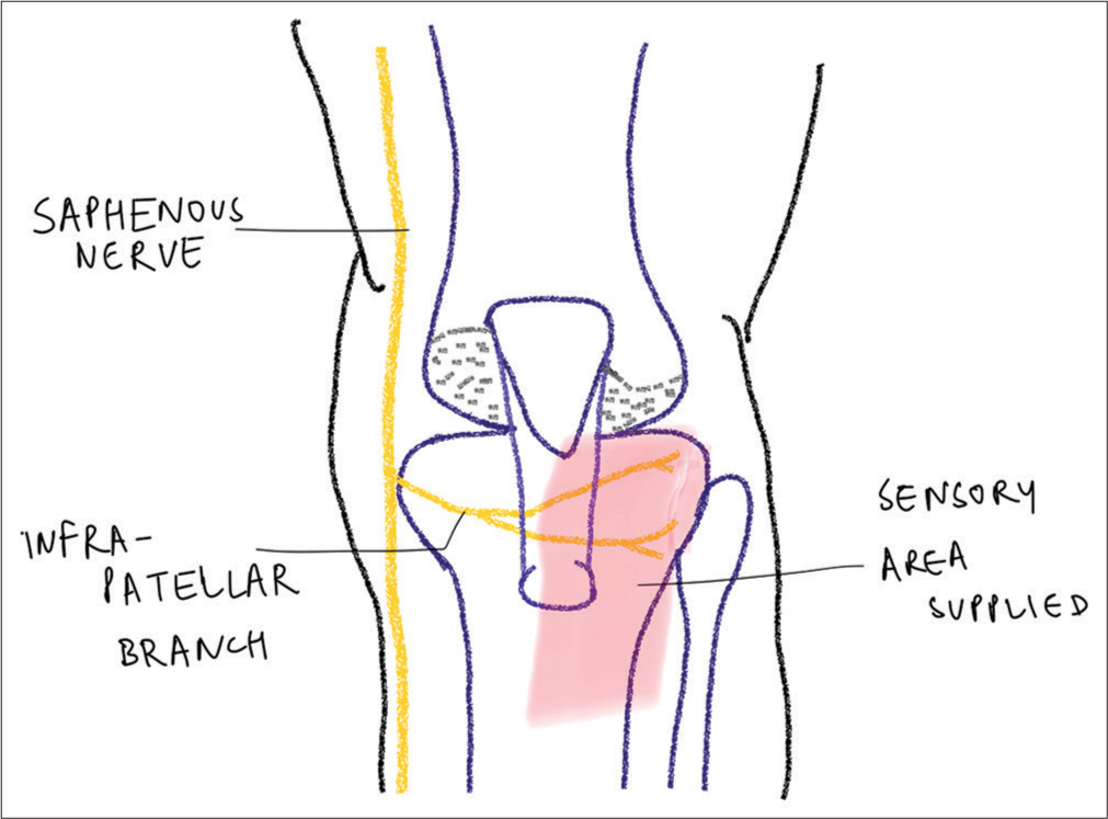 Diagram showing the sensory area supplied by the infrapatellar nerve.