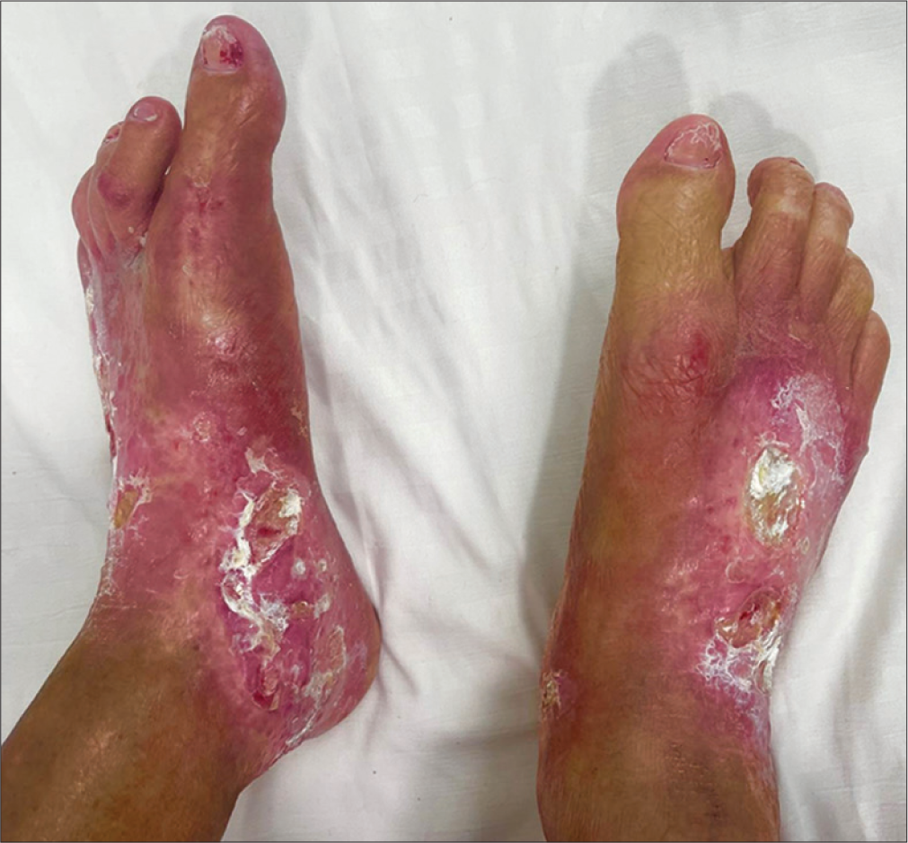 Erythematous shiny indurated plaques with overlying ulcers of varying sizes over the dorsum of both feet.