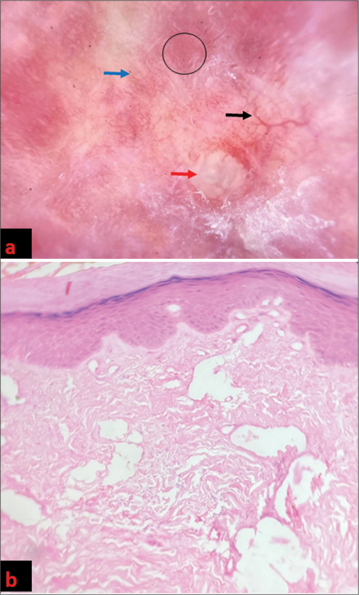 (a) Dermoscopy (DermLite DL4; 3Gen; San Juan Capistrano, California, USA, noncontact polarized mode, ×10 magnification, images capture with DermLite adapter for iPhone 12 pro max) demonstrated white fibrotic beams (blue arrow), yellow structureless areas (red arrow), linear branching (black arrow), and dotted vessels (black circle). (b) Histopathologic examination (HPE) showed closely packed collagen bundles and dilated lymphatics in the dermis at ×20.