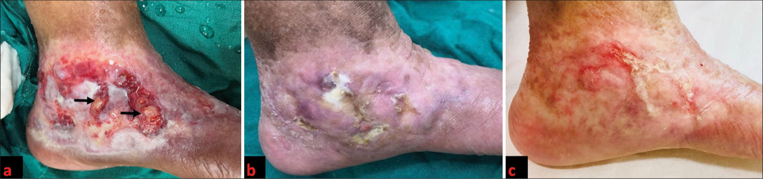 (a) Ulcer base over medial aspect of left foot covered with platelet-rich fibrin (black arrow). (b) Ulcer size reduced after 3rd session. (c) Almost complete healing of ulcer after 4th session at 4 months.