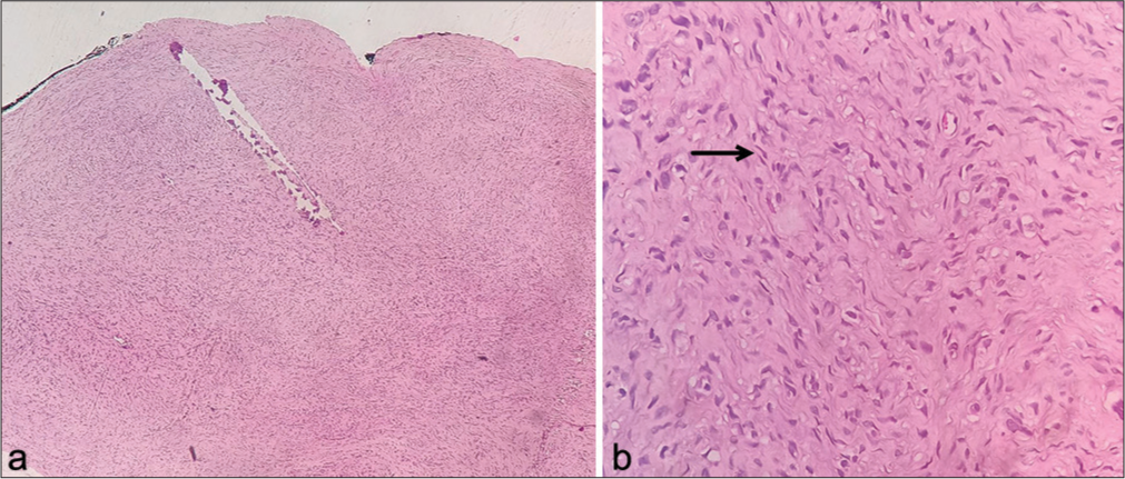 (a) Tumor composed of spindle cells arranged in fascicles. (b) Plenty of individual cells have buckled nuclei, inconspicuous nucleoli, and eosinophilic cytoplasm, some resembling “diving dolphins” (arrow), embedded in a mucopolysaccharide stroma. Hematoxylin and eosin, ×40 (a) and ×400 (b).