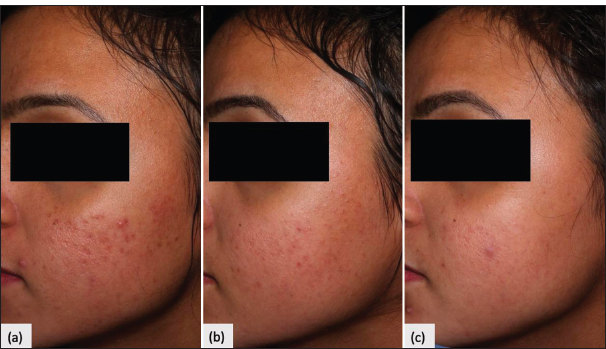 Clinical photo. (a) Baseline macular scars. (b) 50–75% improvement at 2nd follow-up. (c) >75% improvement at 4th follow-up.