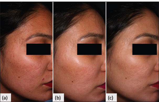 Clinical photo. (a) Baseline moderate scars. (b) 25–50% improvement at 2nd follow-up. (c) 50–75% improvement at 4th follow-up.