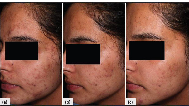 Clinical photo. (a) Baseline mild scars. (b) 50–75% improvement at 2nd follow-up. (c) >75% improvement at 4th follow-up.