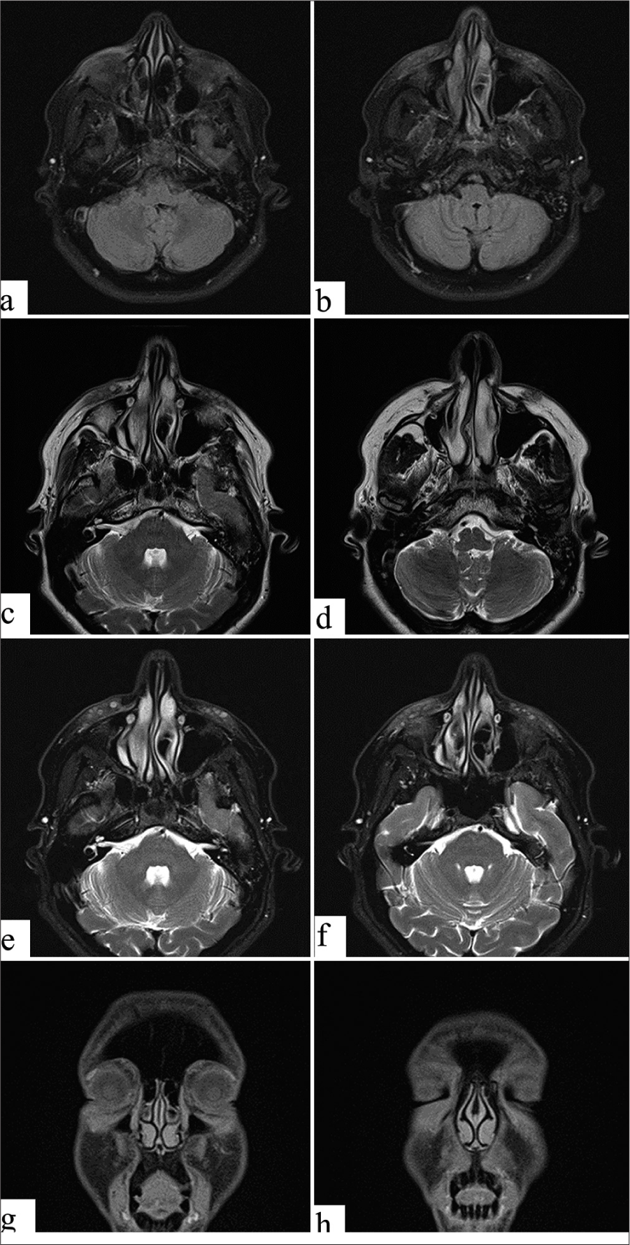 Magnetic resonance imaging. (a and b) Axial fluid-attenuated inversion recovery images showing bilateral cosmetic material injection (fillers) injection seen within the maxilla and nasolabial folds with mild contour asymmetry, being larger on the right. (c and d) Axial transverse relaxation time (T2) images show bilateral tiny multiple foci of high T2 signal rounded material, multiple and more on the left side, being larger on the right. (e and f) Axial T2 Dixon images showing bilateral tiny multiple foci of high T2 signal rounded material, as described above. (g and h) Coronal longitudinal relaxation time (T1) Dixon images showing bilateral tiny multiple foci of intermediate to low T1 signal rounded material, as described above. No evidence of localized collection, distal migration, granulomatous changes, fibrotic changes, or scars.