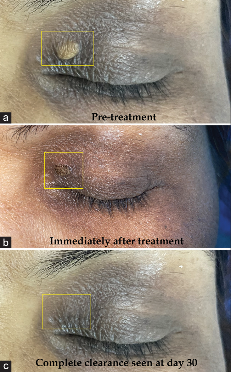 Superficial ablation of xanthelasma palpebrarum (yellow rectangle) with ionized plasma jet therapy (IPJT) ((a) – Pre-treatment at day 0, (b) – Immediately post-treatment thin crusts seen, (c) – Complete clearance of xanthelasma in a single sitting at day 30).