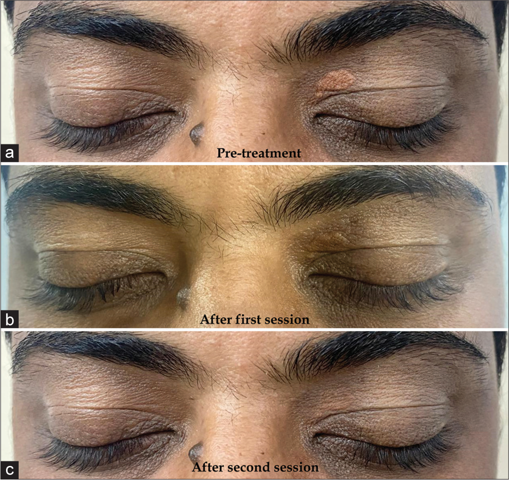 Patient presentation of bilateral xanthelasma palpebrarum lesions requiring two sessions ((a) – Pre-treatment, (b) – After the first session at day 30, c – After the second session at day 90).