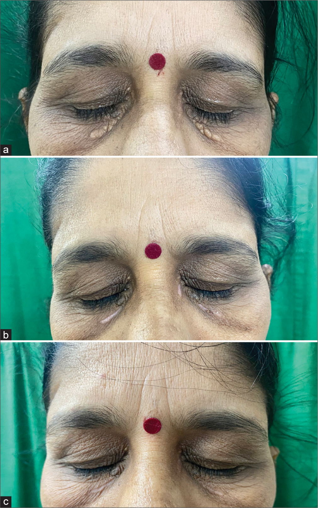 Patient presentation of bilateral xanthelasma palpebrarum lesions developed hypopigmentation ((a) – Pre-treatment, (b) – After 1 session at day 7, (c) – Post-treatment day 90).