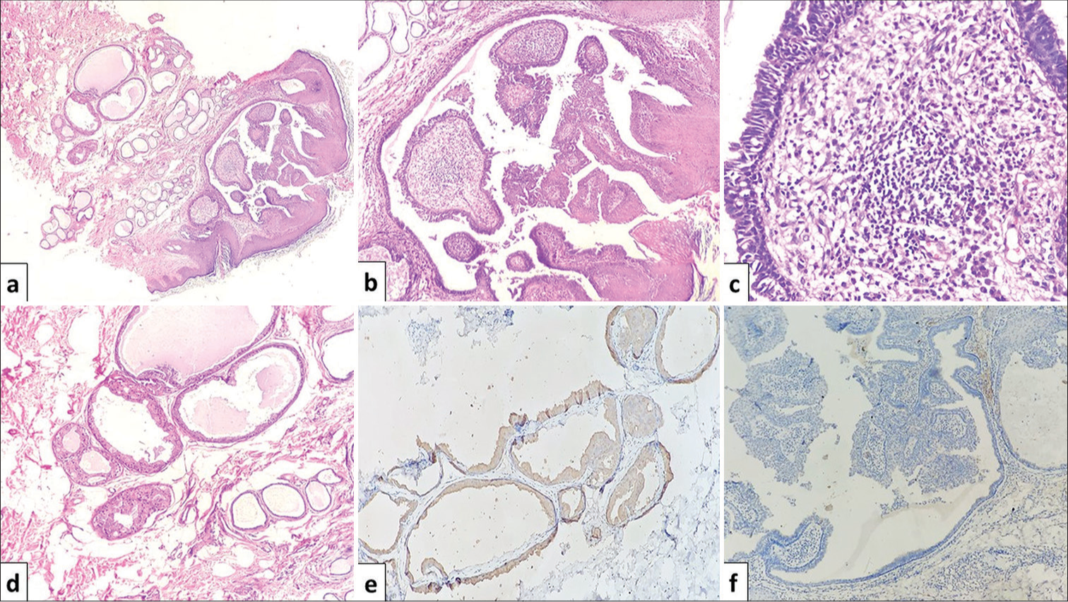 Photomicrographs of tumor, (a) syringocystadenoma papilliferum (SCAP) in the upper dermis and tubular apocrine adenoma in deep dermis (Hematoxylin and eosin [H&E]; ×200), (b) acanthotic epidermis with underlying cystic invaginations thrown into papillae, lined by two layers of epithelium, inner columnar cells and outer layer of cuboidal cells; suggestive of SCAP (H&E; ×100), (c) papillae lined by double-layered epithelium with intervening stroma showing inflammatory infiltrates, predominantly plasma cells (H&E; ×400), and (d) variably dilated round to oval tubules in deep dermis lined by apocrine cells, some containing eosinophilic amorphous secretions (H&E, ×200). (e) Luminal cells of tubular apocrine adenoma showing positive reaction to Gross cystic disease fluid protein 15 (GCDFP-15) (×200) and (f) Negative staining result to GCDFP-15 in syringocystadenoma papilliferum (×100).