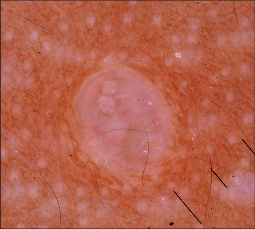 Dermoscopy of lesion showing white structureless areas with peripheral telangiectasias.