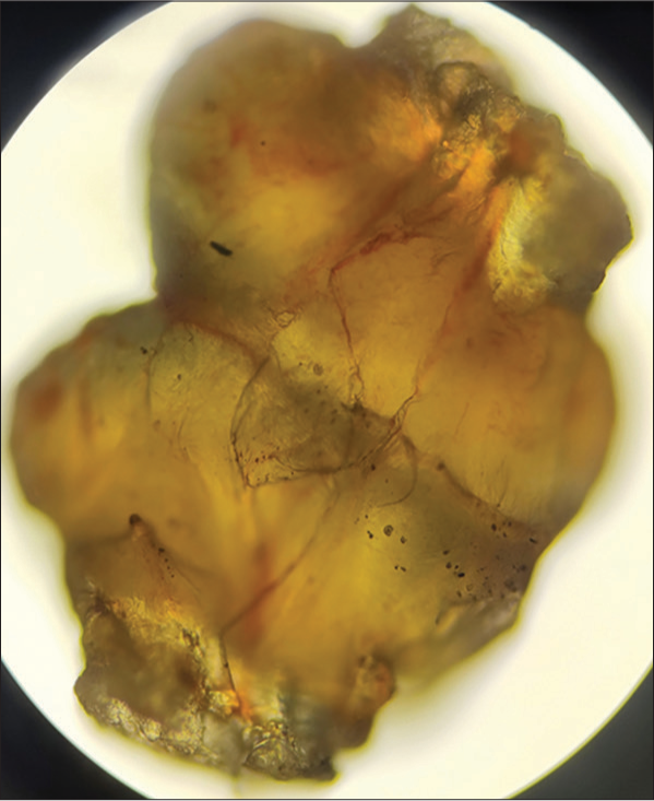 Microscopic view (×10 ×10) of the enucleated lobule.