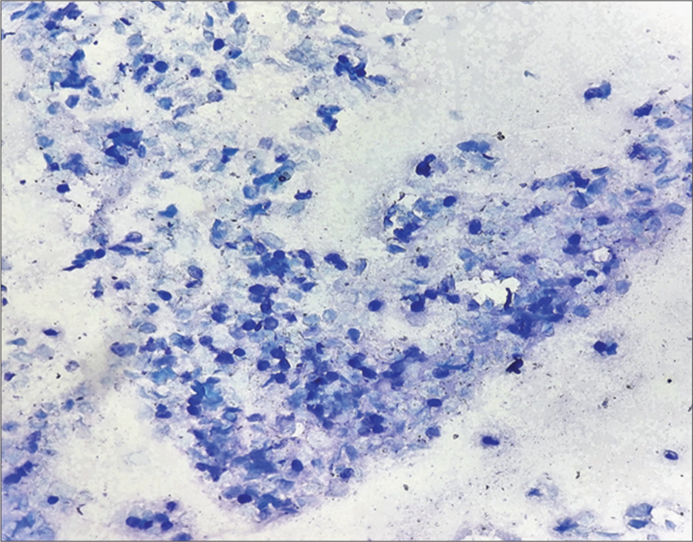 Tissue smear of the enucleated lobule showing numerous intracytoplasmic basophilic inclusion bodies in low power (×10 ×10).