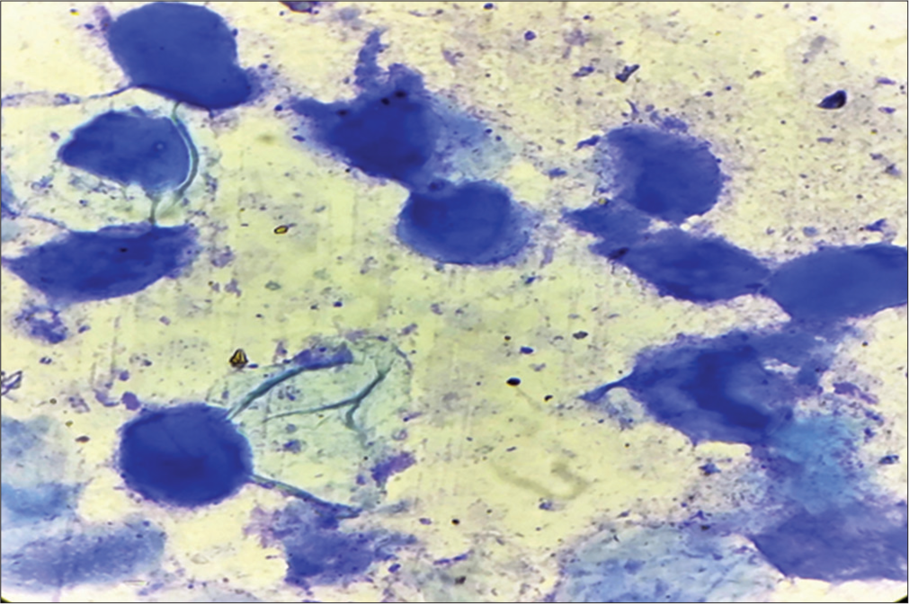 High-power (100 × 10) view of intracytoplasmic inclusion bodies (Molluscum bodies).