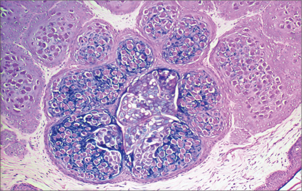 Histopathological examination showing altered keratinocytes with numerous intracytoplasmic eosinophilic inclusion bodies.