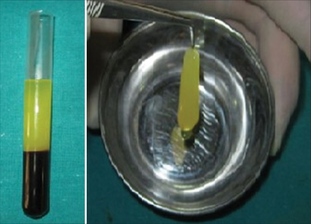 Preparation of platelet-rich fibrin.