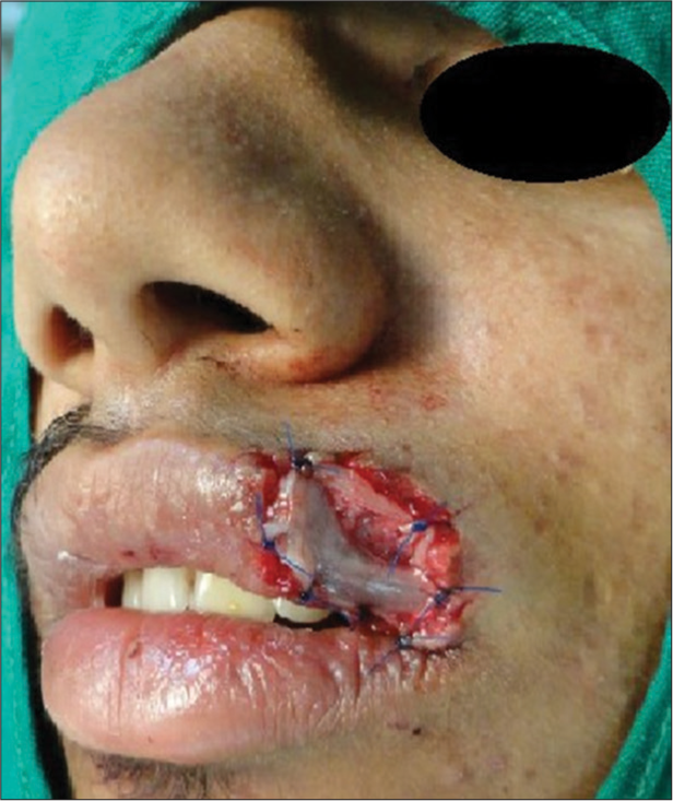 Platelet-rich fibrin membrane sutured to the lip defect with 4–0 prolene.