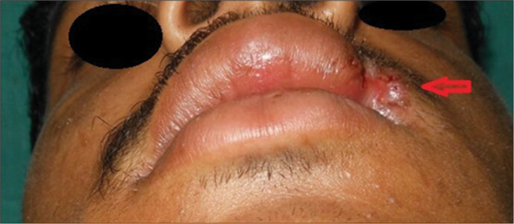 Gradual decrease in the size of the defect (red arrow) with no signs of inflammation and infection.