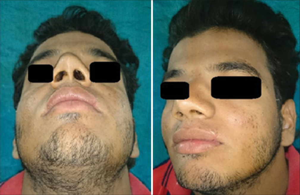 Satisfactory regeneration of the lost lip tissues at the end of 3 months.