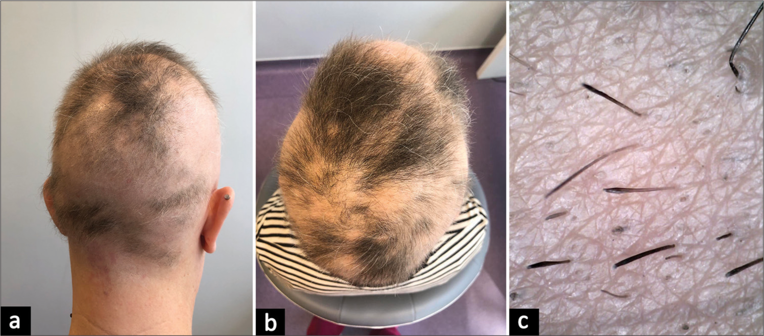 (a and b) Case 1 at baseline, severity of alopecia tool 65. (c) Trichoscopy of case 1 at base line: Black dots, exclamation mark hairs.