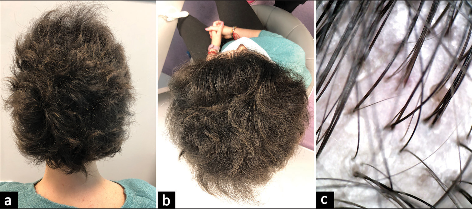 (a and b) Case 1: 3 months after the last platelet-rich plasma application, severity of alopecia tool 0. (c) Trichoscopy of case 1 at follow-up: Upright regrowing hairs, pigmented terminal hairs, increased hair shaft thickness.